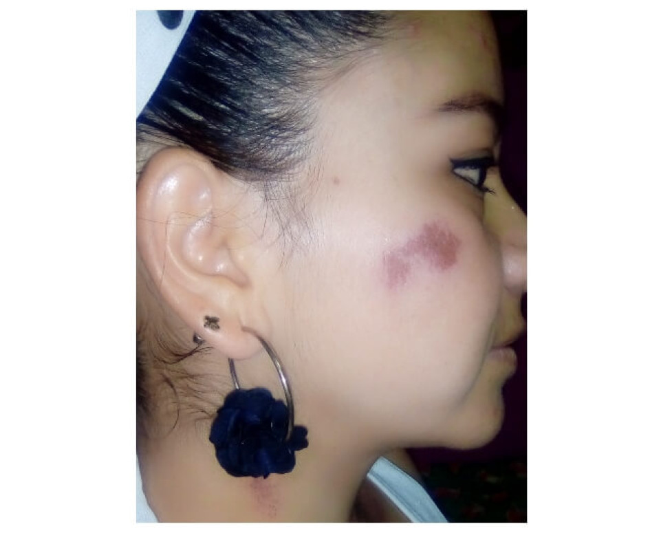 Gas pimienta, el dilema de cargarlo sin usarlo: caso de mujer atacada en Pácora