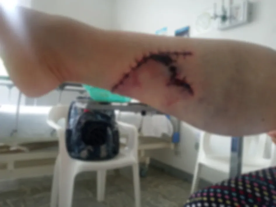 Así quedó la pierna de la afectada. Así quedó la pierna de la afectada.