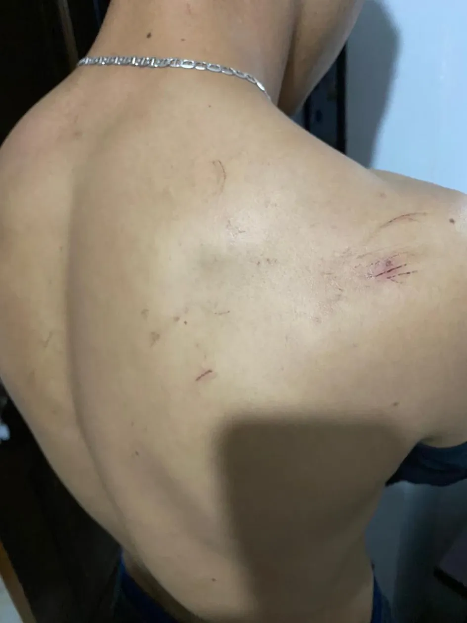Lesiones que dice haber sufrido el denunciante tras el enfrentamiento con el otro hombre. Lesiones que dice haber sufrido el denunciante tras el enfrentamiento con el otro hombre.
