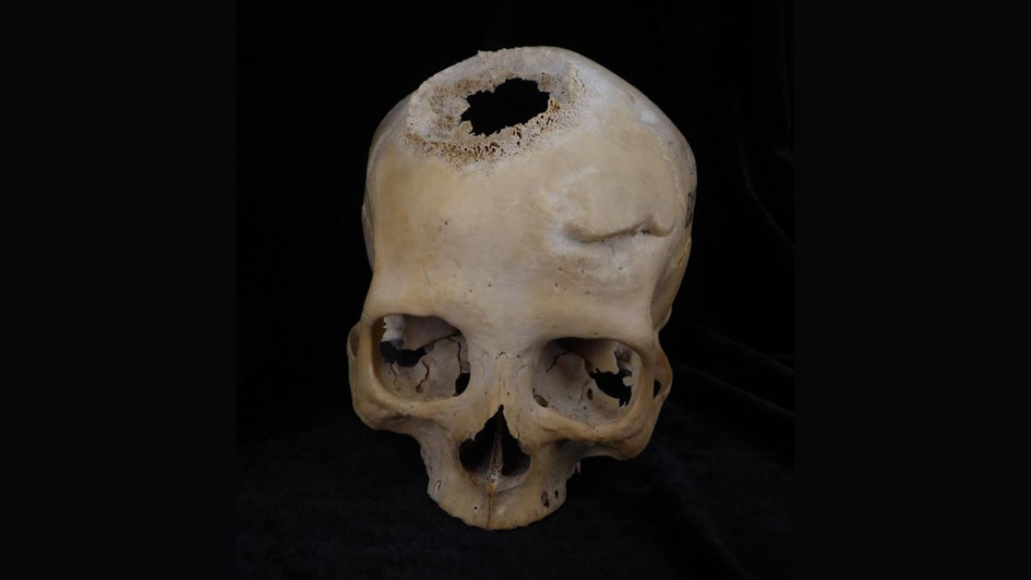 Imagen de un cráneo datado entre el 663 y el 343 a.C., y perteneciente a una mujer de más de 50 años. En la parte izquierda del cráneo se aprecia el fuerte traumatismo al que sobrevivió años antes de morir, y arriba a la derecha, el agujero causado por la neoplasia. Imagen de un cráneo datado entre el 663 y el 343 a.C., y perteneciente a una mujer de más de 50 años. En la parte izquierda del cráneo se aprecia el fuerte traumatismo al que sobrevivió años antes de morir, y arriba a la derecha, el agujero causado por la neoplasia.
