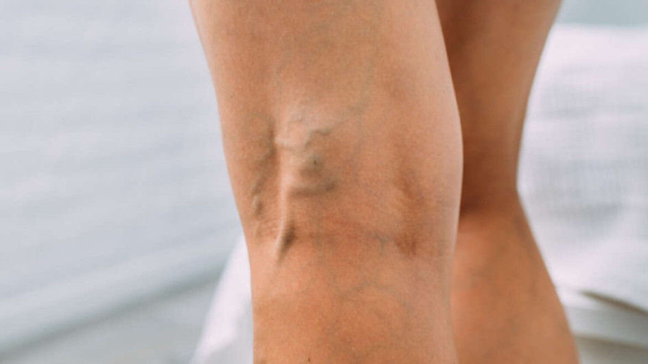 Piernas Várices