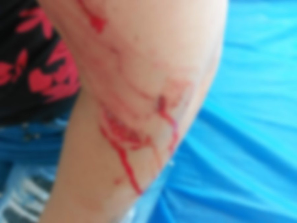 Estas son las lesiones provocadas por el perro de manejo especial en la residente de Salamina. Estas son las lesiones provocadas por el perro de manejo especial en la residente de Salamina.