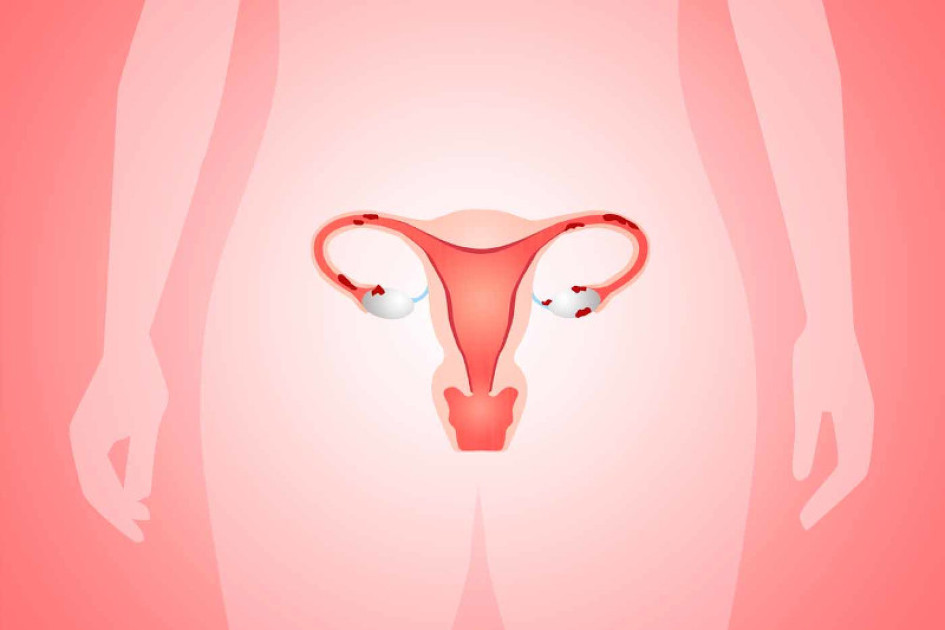 Cáncer de cuello uterino Cáncer de cuello uterino