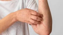 La OMS rebautiza la viruela del mono como mpox para evitar estigmatización